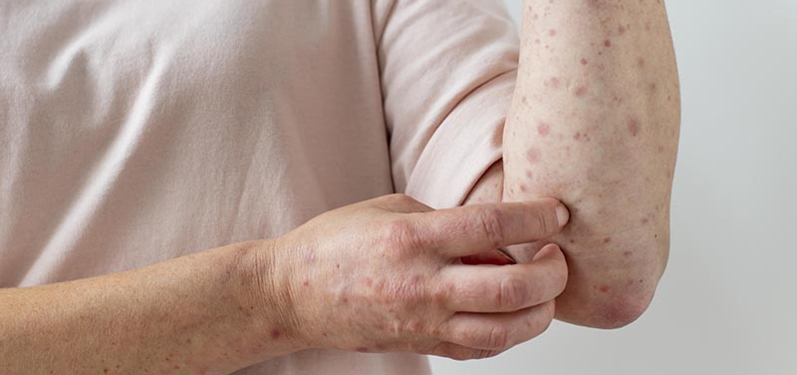 Imagem de Bahia registra dois casos confirmados de Mpox em 2026