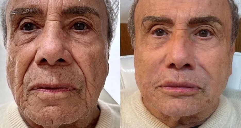 Imagem de Stenio Garcia faz harmonização facial e resultado repercute na web